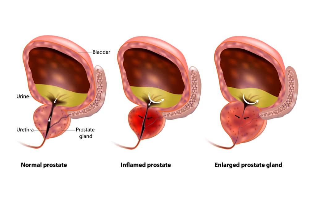 You are currently viewing The Proven Way of Improving Prostate Health