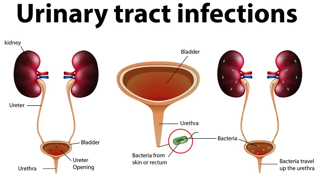 Urinary Tract Infections