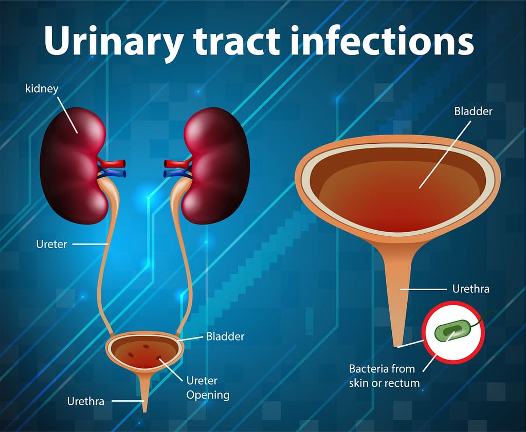 Urinary Tract Infections