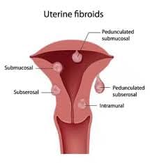 Fibroid in The Womb
