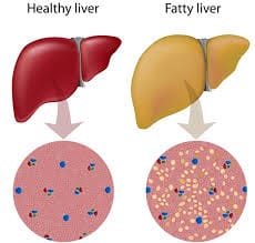 Read more about the article The Ultimate Guide To Reversing Fatty Liver Everyone Should Know