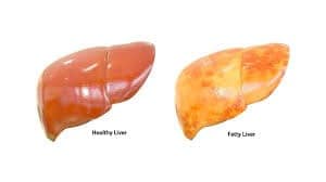 Fatty Liver