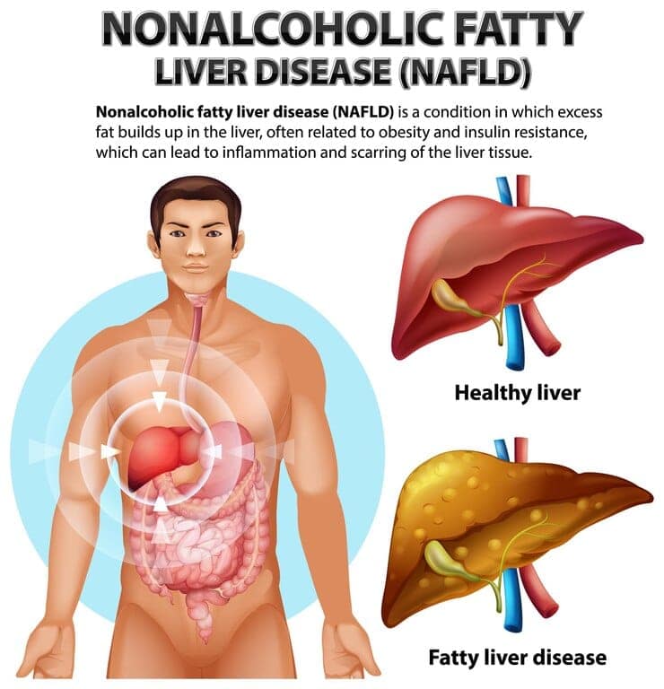 Fatty Liver disease And Mortality