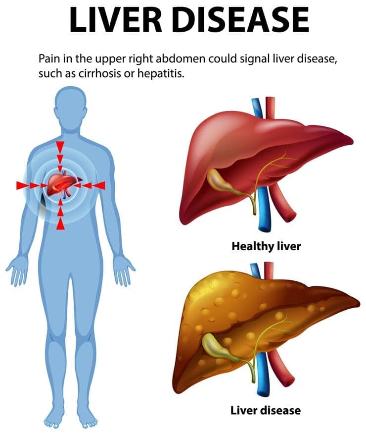 Fatty Liver