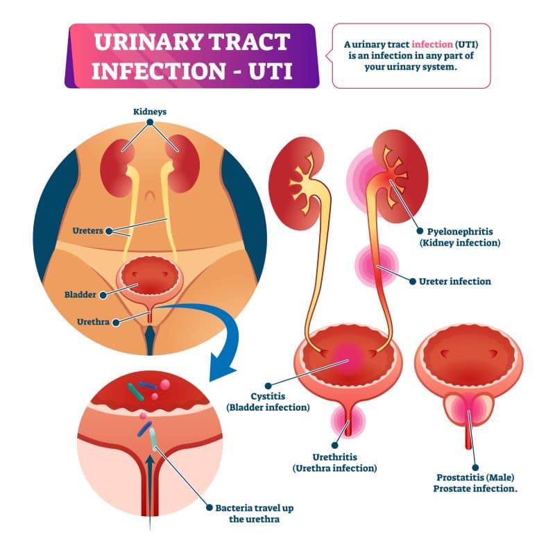 Urinary Tract Infections